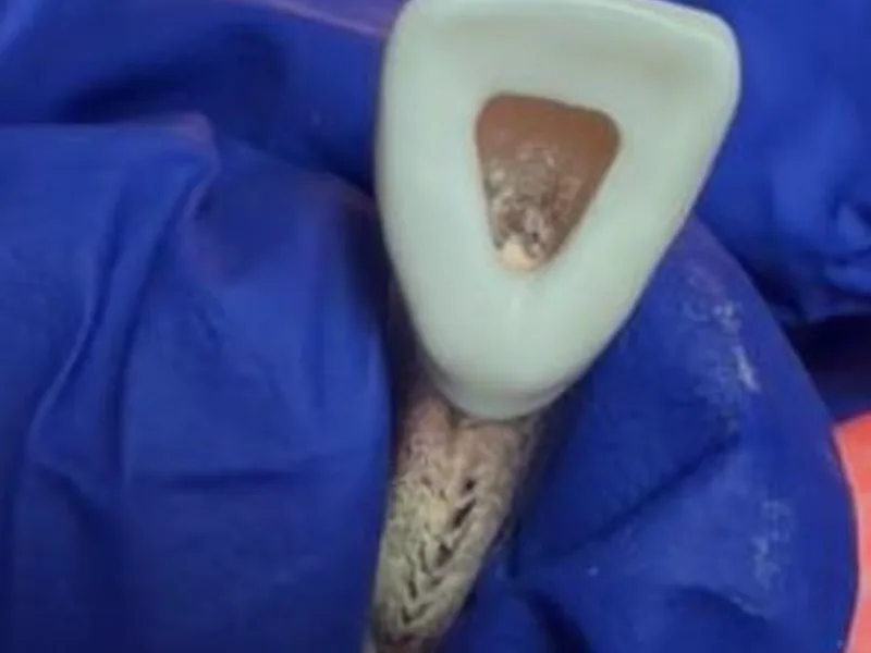 Lingual access opening of an incisor: a rounded triangle over the pulp chamber with tooth structure intact on all sides