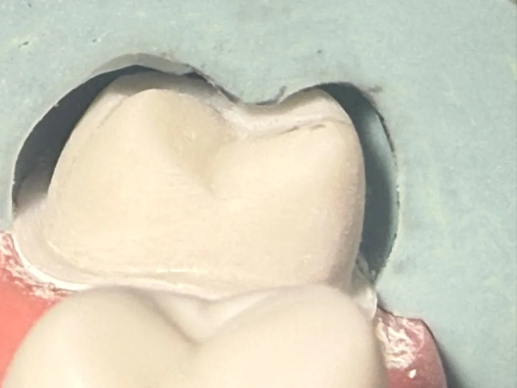 A molar crown preparation on a typodont, occlusal view
